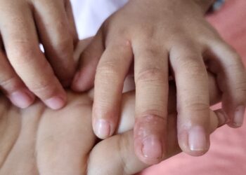 SSM descarta brote de virus de Coxsackie en la entidad