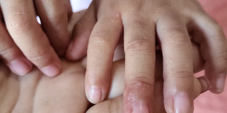 SSM descarta brote de virus de Coxsackie en la entidad